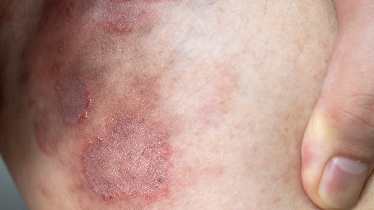 NYC Finds Cases of Drug-Resistant Skin Infection Never-Before-Seen in US